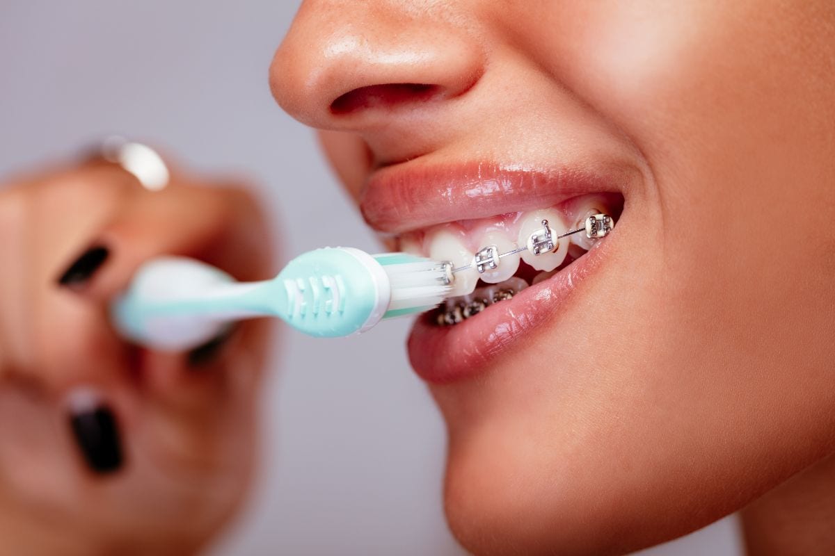 Top Tips For Brushing While You’re In Braces