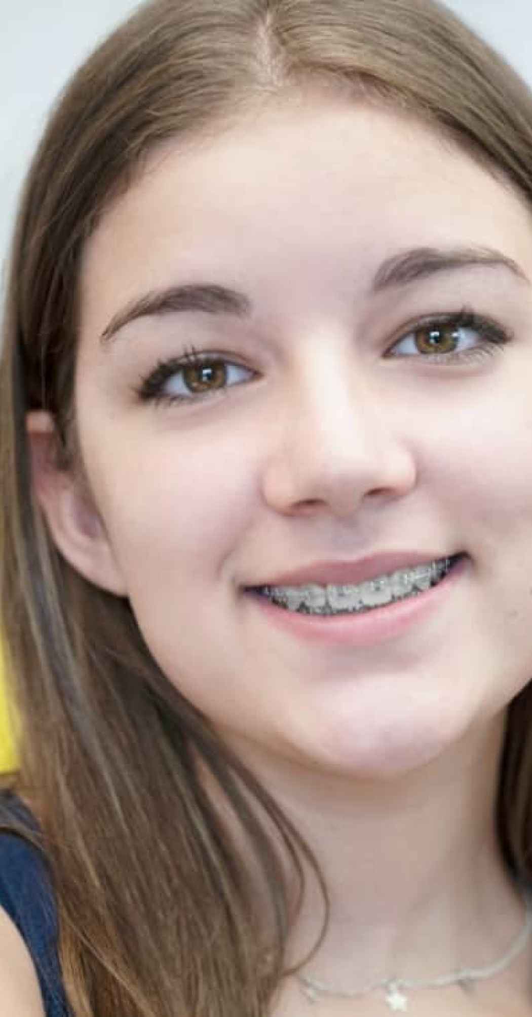 simple affordable braces for teens