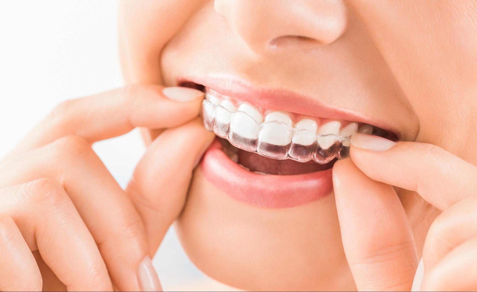 Invisalign Gloucester